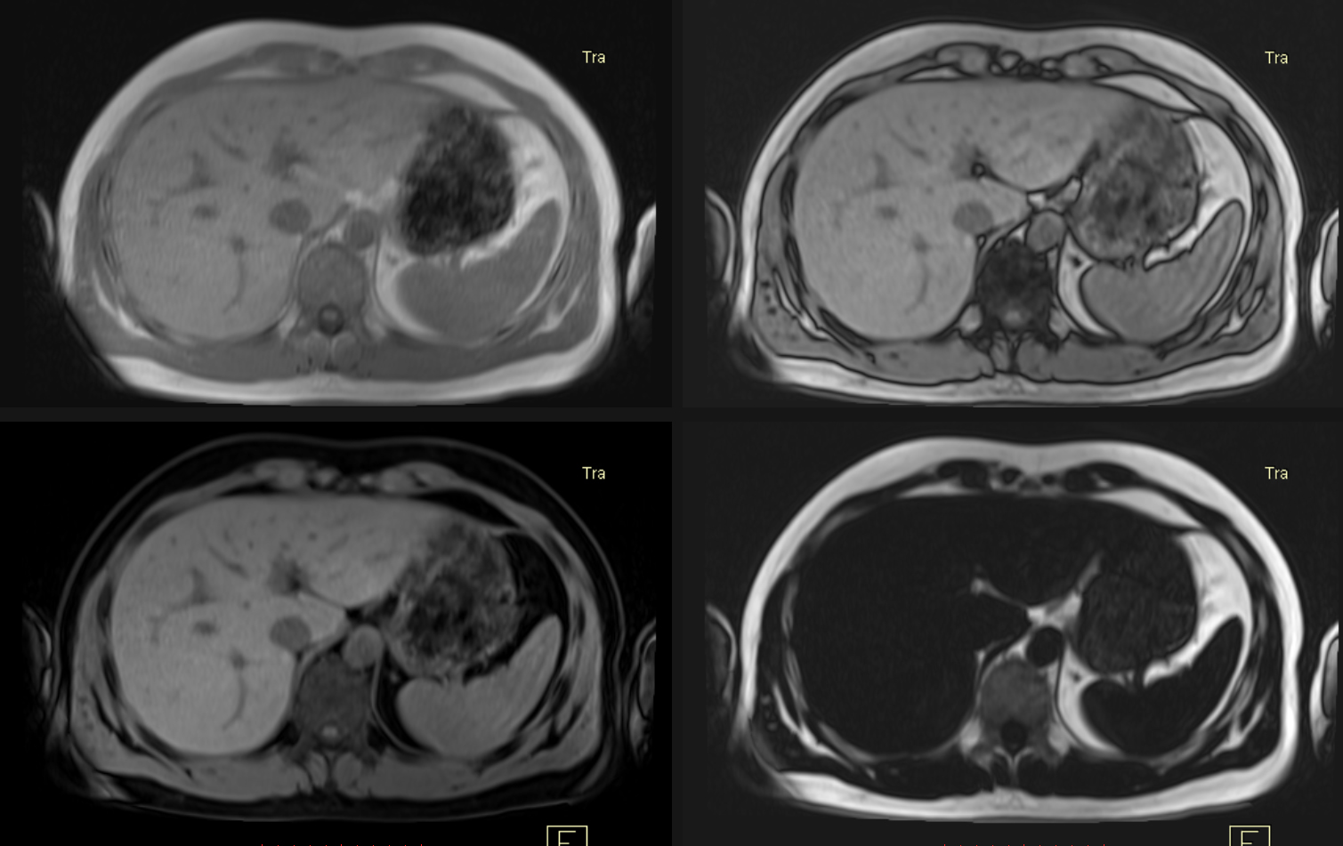 MRI Imaging on liver. Photo courtesy: aimmedicalimaging.com