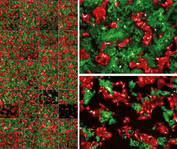 Personalised screening for drug sensitivity in patient-derived models. Green cells represent the primary tumour cells while the red cells represent metastatic tumours. The different micrographs represent the effect of drug treatment on primary versus metastatic tumour models derived from the same patient.