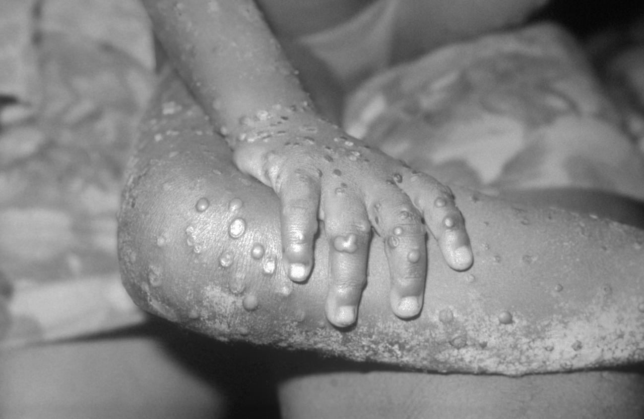 Monkeypox. Photo courtesy: Wiki