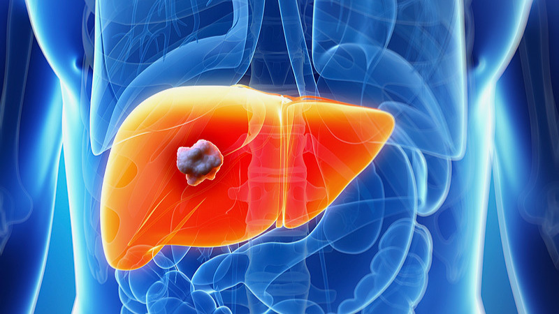 Medical experts in Singapore combine two treatments to treat liver cancer