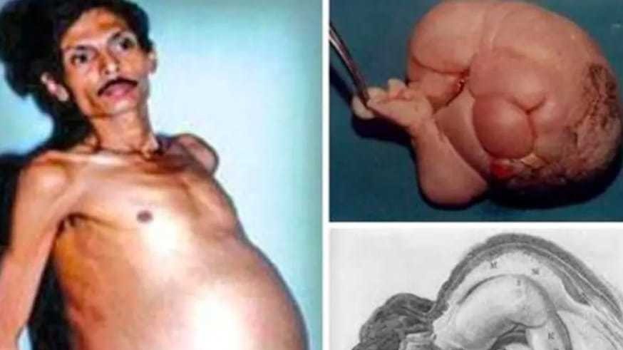 Nagpur man, who was ‘pregnant’ for 36 years, finally delivered his vanished twin