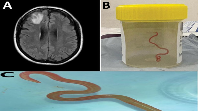 Australia: Rare medical procedure saw doctors removing live worm from woman’s brain