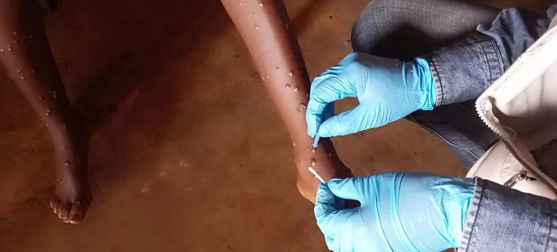 Three Delhi govt hospitals directed to set up mpox rooms for suspected patients 