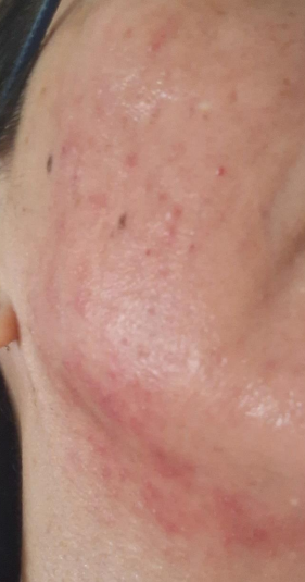 Skin inflammation