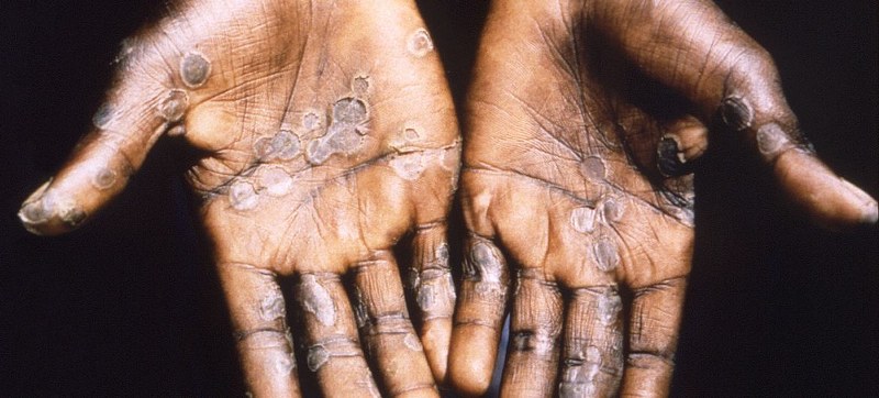 DR Congo begins mpox vaccination in high-priority provinces
