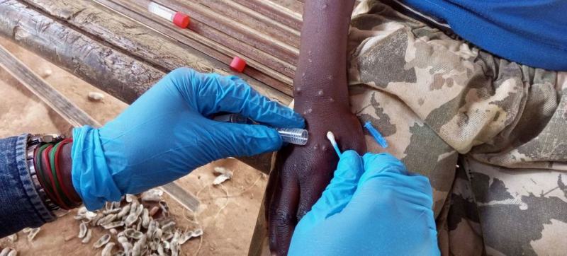 Mpox: WHO approves first diagnostic test for emergency use