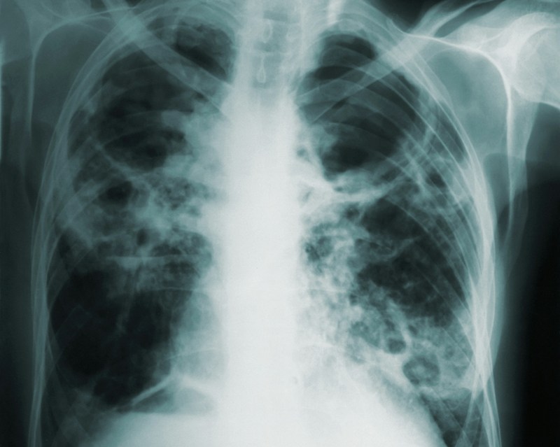 TB replaces COVID-19 as leading infectious disease killer in 2023: WHO report